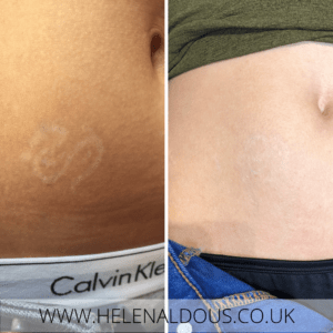 Scar Camouflage of Laser Tattoo Removal