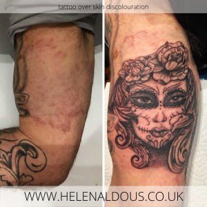 Camouflage Tattoo over Skin Discolouration